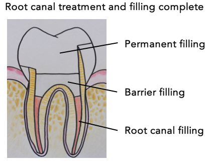 Treatment Steps – Root Canal Treatment